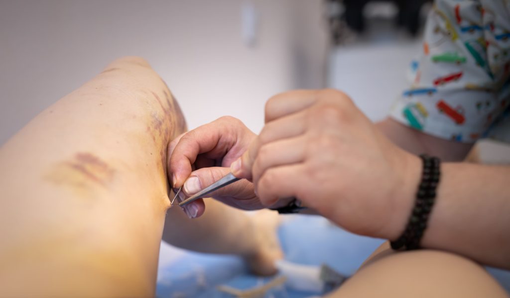 What Are the Advantages Of Endovenous Laser Ablation