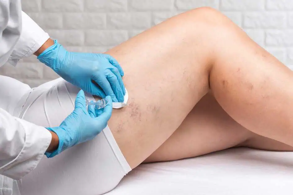 Sclerotherapy in Brea, CA by occosmeticandvein.com