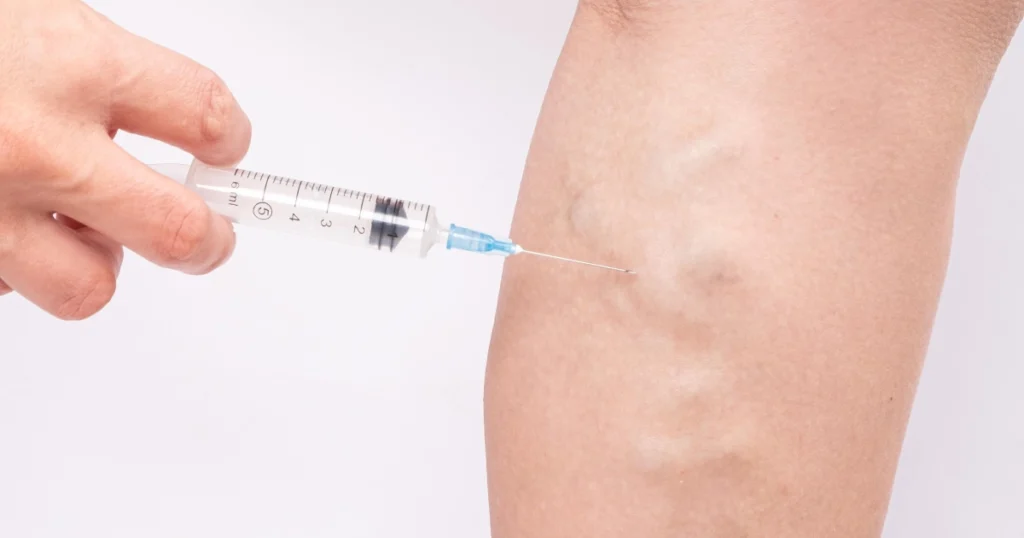 A person's leg with prominent varicose veins undergoing Endovenous Laser Ablation in Brea, CA.